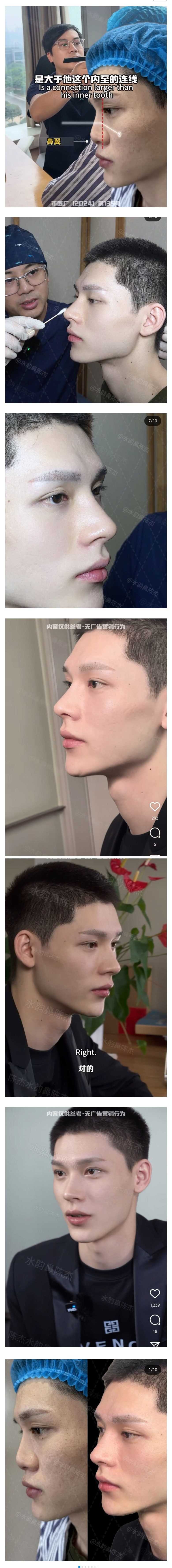 남자 코성형 레전드 ㄷㄷㄷ